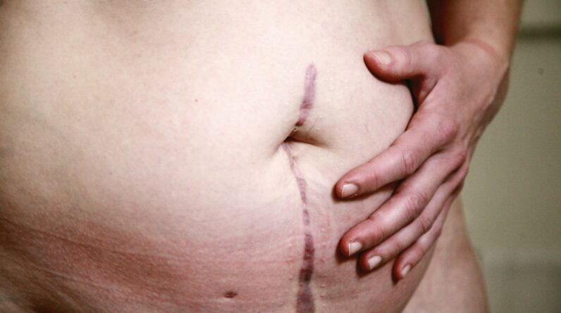 Photo Abdominal Fat Loss Progress