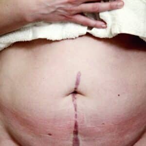 Photo Abdominal Fat Loss Progress