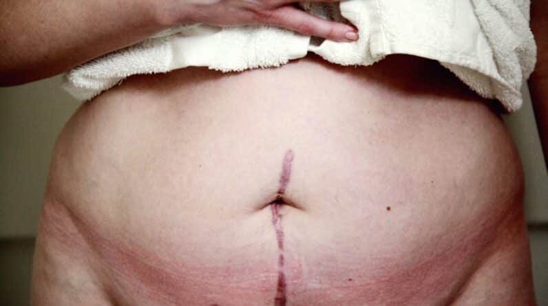 Photo Abdominal Fat Loss Progress